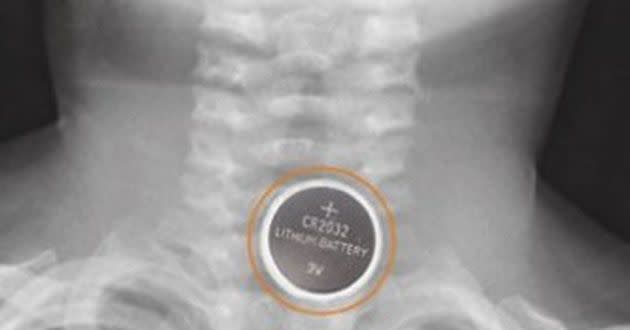 An X-Ray shows where the battery was lodged in Summer's oesophagus.