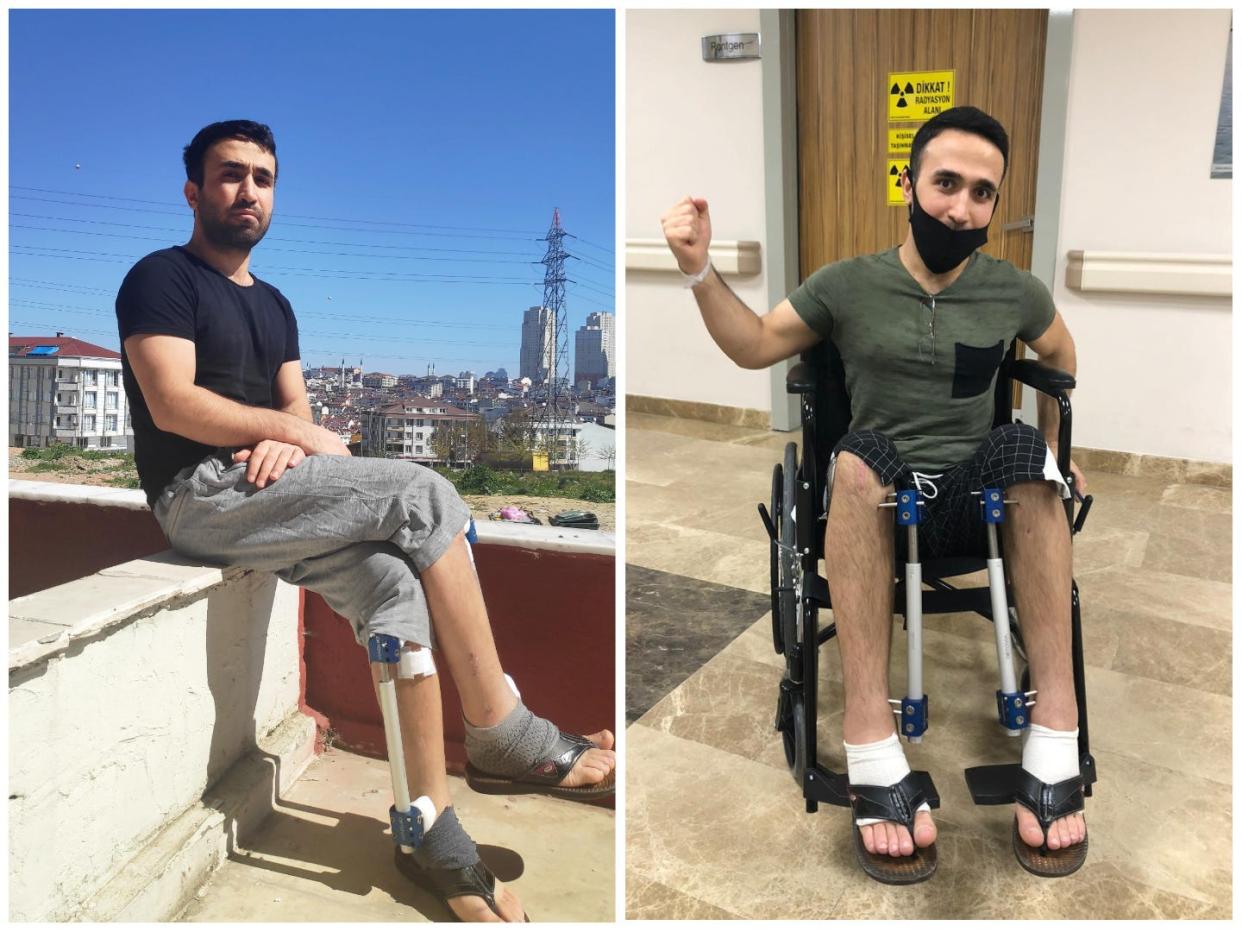 Ibrahim Alğan, in a wheelchair after surgery, right, and sitting outside after one of his surgeries. He paid nearly $30,000 to make his legs longer with surgery.