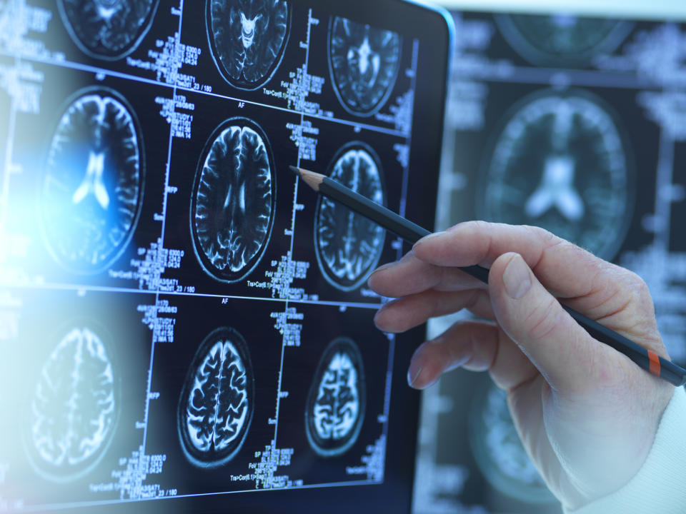 Scientists observed brain damage, strokes and central nervous system infections. (Stock, Getty Images)