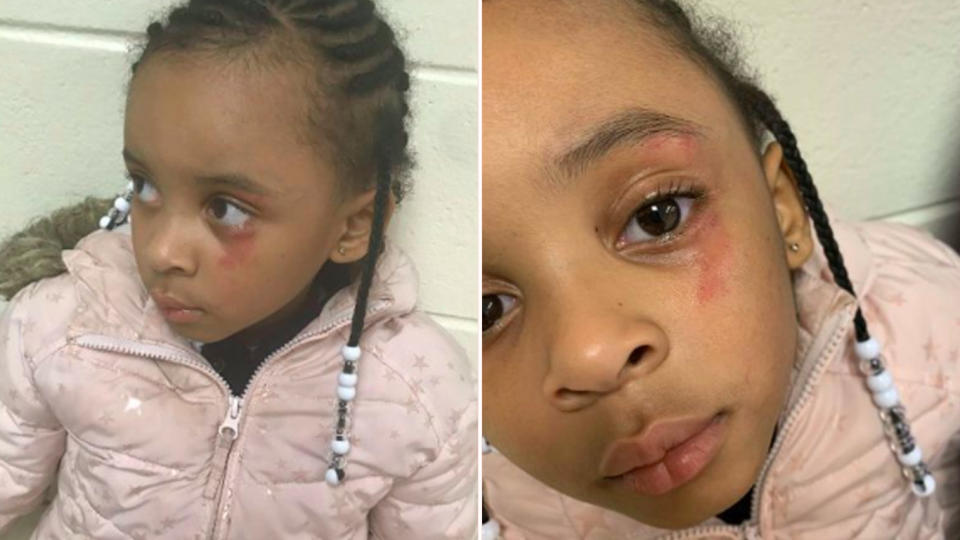 The mother of a five-year-old girl says that her daughter was hit with a ruler by her kindergarten teacher, leaving her with a bruise around her eye. Source: Yahoo Lifestyle