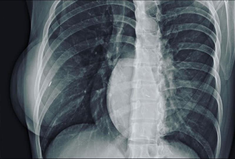 有網友貼出一張女性X光片，直指隆乳後拍攝出來的結果會有兩顆圓球白影。（圖／翻攝爆廢公社）