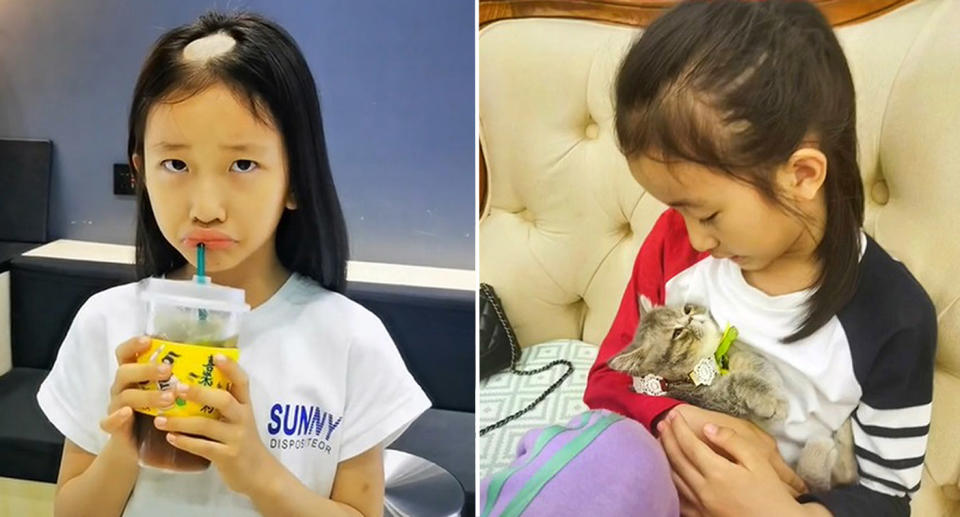 The young girl is seen with her new bald spot and with the adopted cat. Source: AsiaWire/Australscope