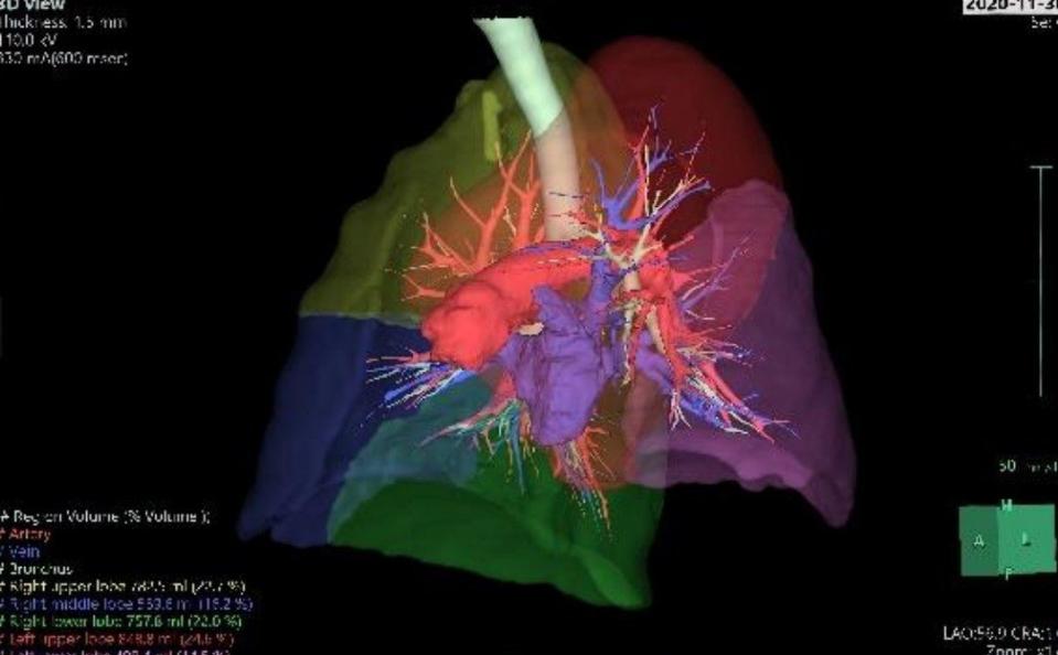 A 3D reconstruction of a CT scan showing Mr Cheng's lungs