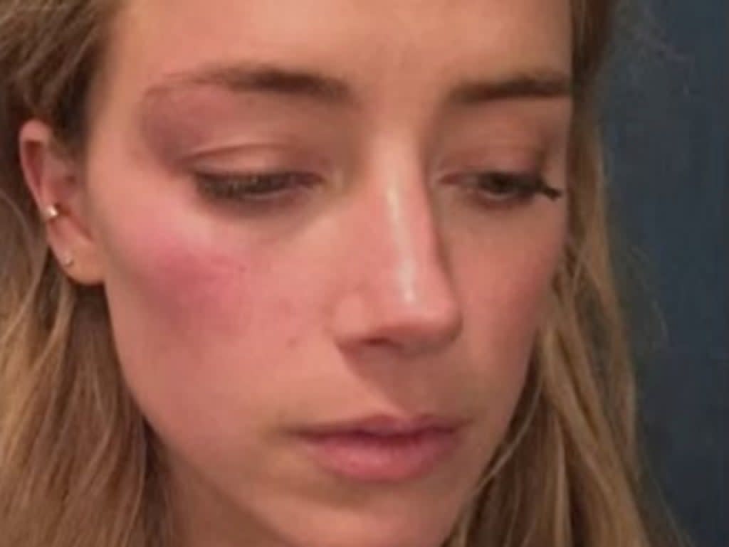 La abogada de Johnny Depp acusó a Amber Heard de retocar las fotos de su cara con heridas como la de arriba (Fairfax County Court)