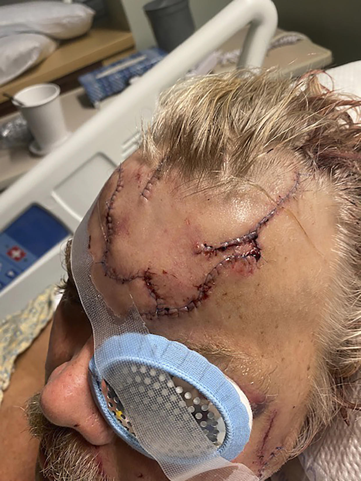 This May 18, 2021, photo, provided by Allen Minish shows lacerations on Minish's head as he recuperates at a hospital in Anchorage, Alaska, following a mauling by a brown bear. The bear charged Minish after a chance encounter in a wooded area near Gulkana, Alaska, and he estimated the encounter lasted less than 10 seconds. (Courtesy of Allen Minish via AP)