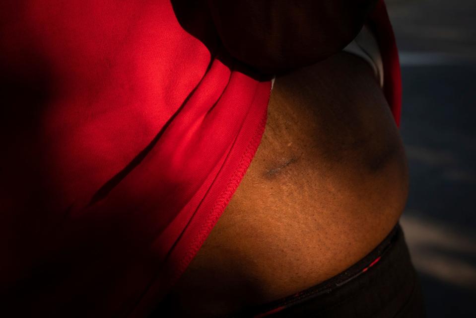 Timothy Rives, 38, shows a bullet scar from being shot by the Detroit police in 2021, while standing in his Detroit neighborhood on Tuesday, June 20, 2023. "To tell me they didn't do nothing wrong is to tell me I don't have any rights as a human," said Rives.