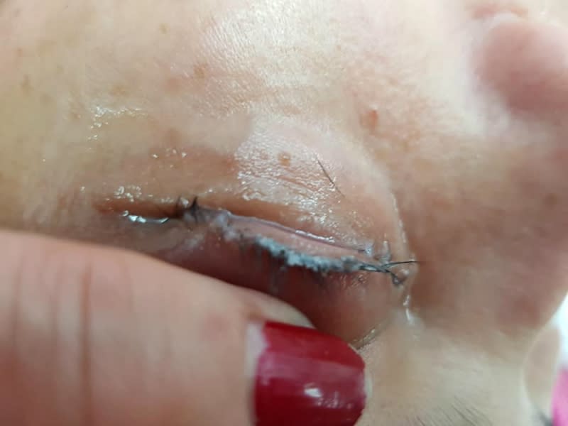 A woman’s eyes were glued shut and swollen after super glue had been used to attach her eyelash extensions instead of cosmetic adhesive. [Photo: Facebook/Fara Beautysalon]