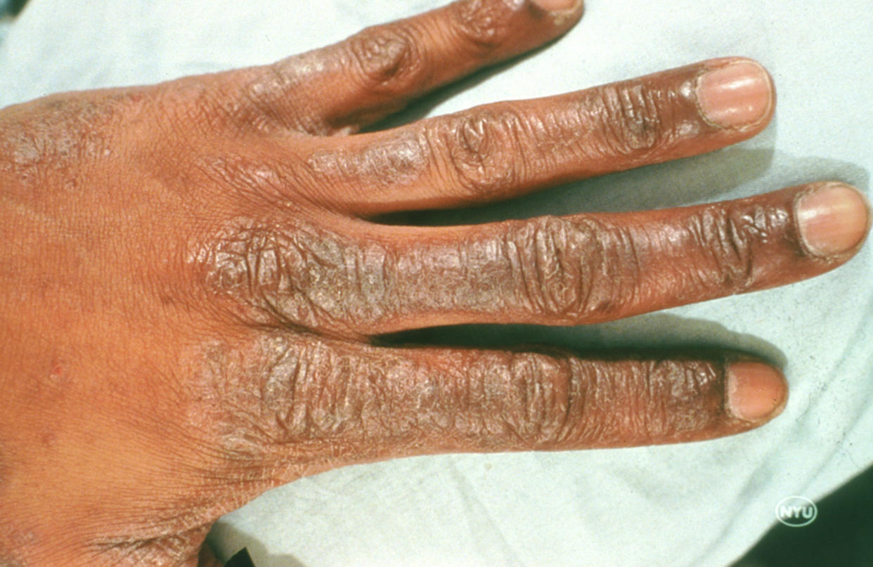 Photos of contact dermatitis and what causes contact dermatitis (American Academy of Dermatology National Library of Dermatologic Teaching Slides)