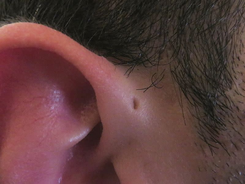 Preauricular sinus.jpg