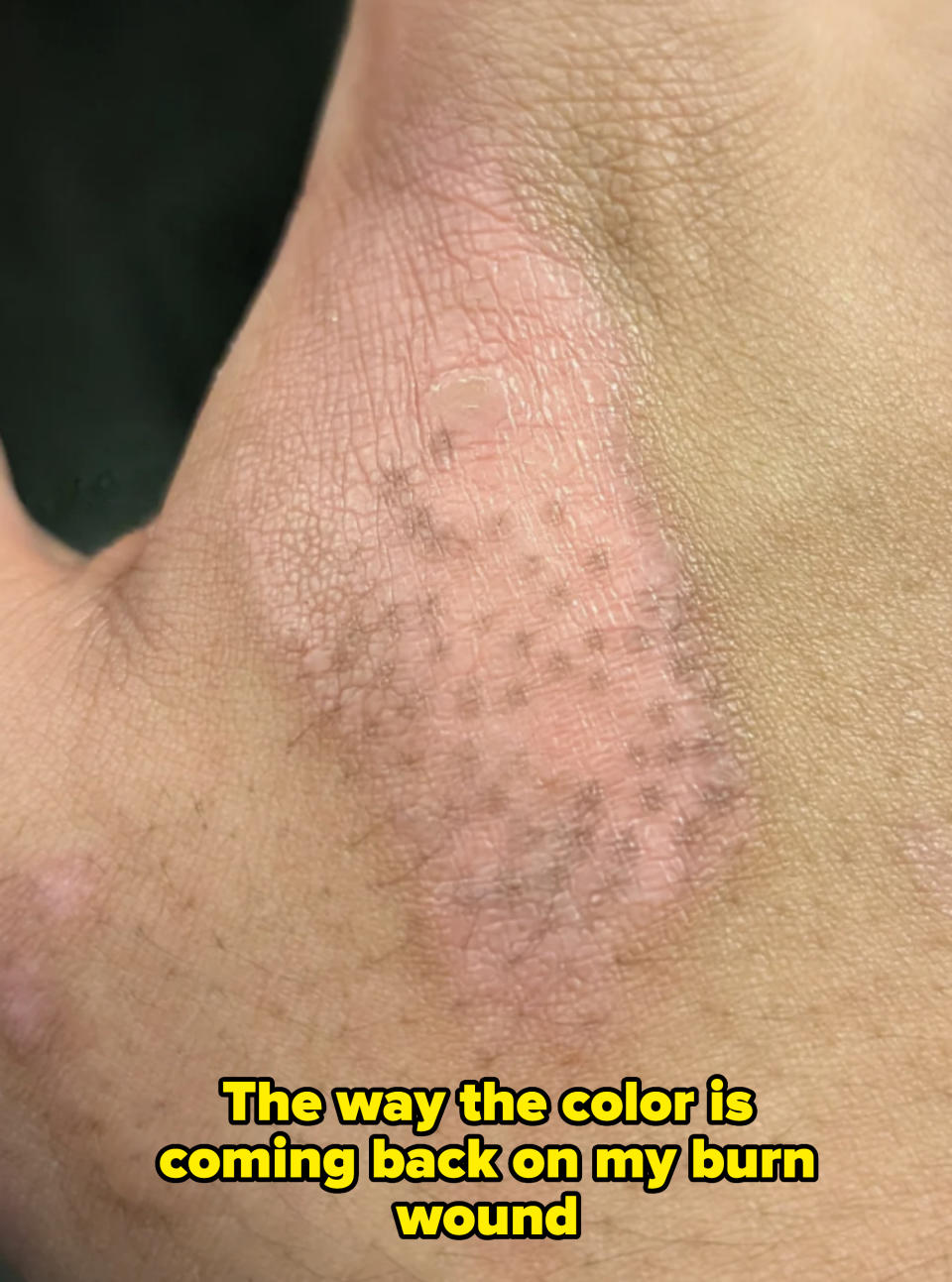 Close-up of a hand showing a patch of irritated skin with redness and dryness