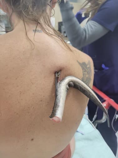 A stingray barb is seen piercing Kristie Cataffo-O’Brien’s back after an incident at a beach in Ruskin, Florida. (Kristie Cataffo-O’Brien)