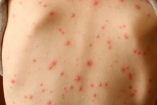 Skin rash should be considered key symptom of coronavirus, say scientists