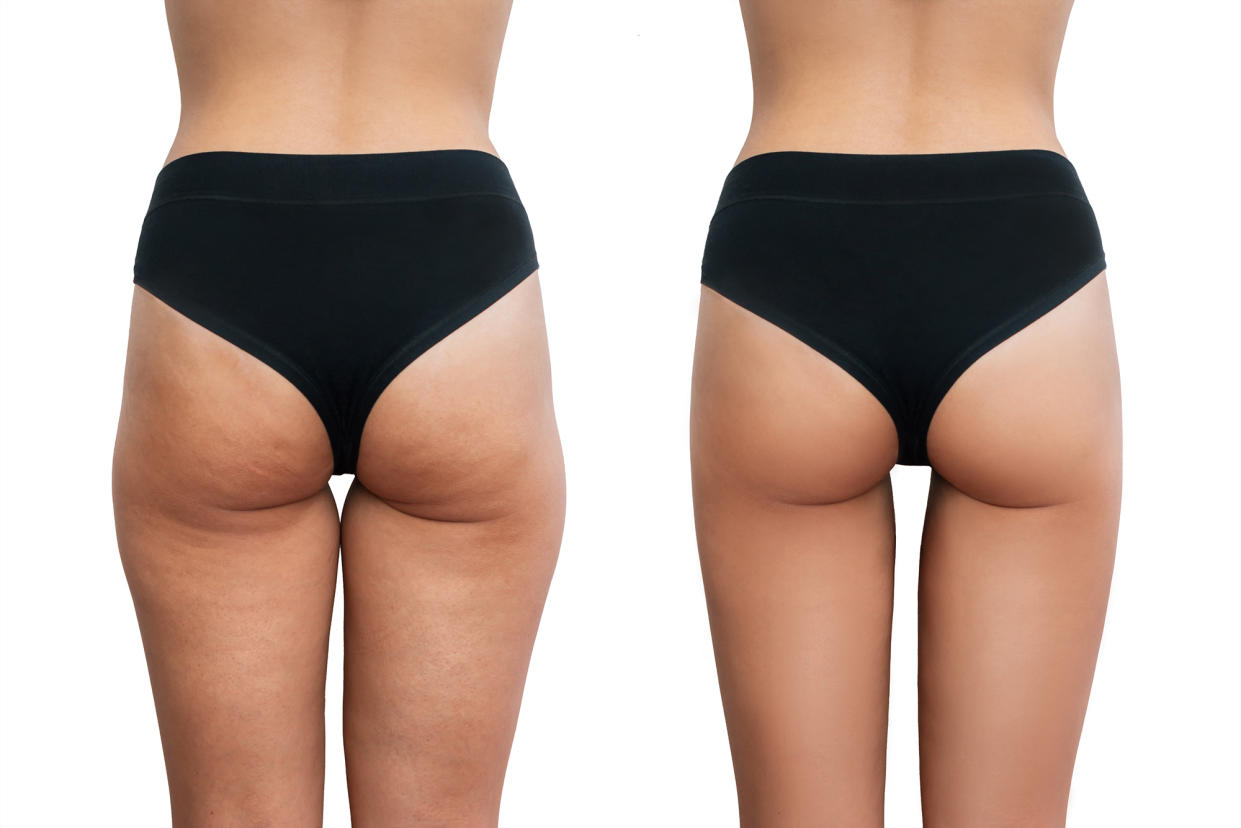 Young woman's thighs with cellulite before and after treatment isolated on white background.