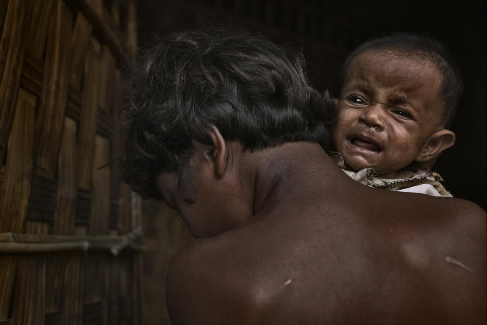 A child suffering from malnutrition in one of the camps is held by its mother.