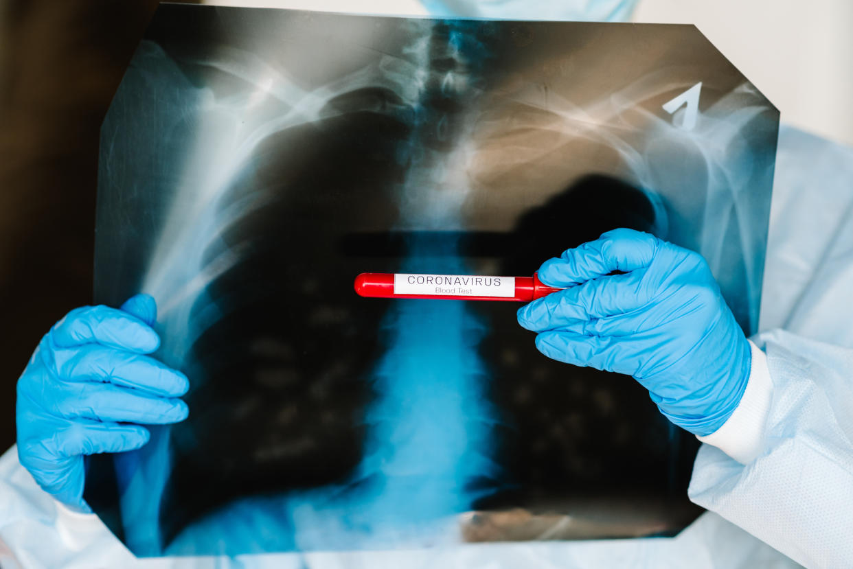 El binomio EPOC y Covid-19 contribuye a un peor pronóstico y una mayor tasa de mortalidad porque el pulmón ya está dañado una vez entra el virus SARS-CoV-2. Por tanto, no tiene la misma capacidad de recuperación que un pulmón sano. (Foto: Getty Images/iStockphoto)