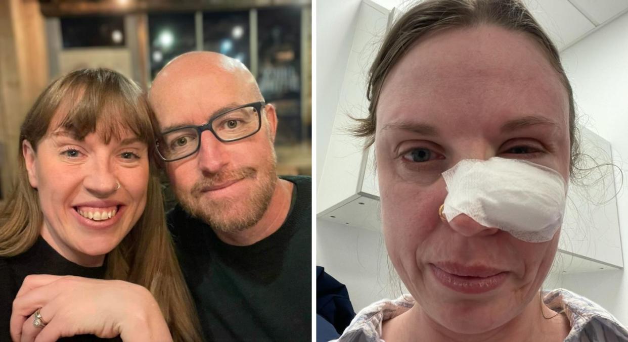 Sarah Trushell's under eye bump turned out to be skin cancer that required surgery. (Sarah Trushell/SWNS)