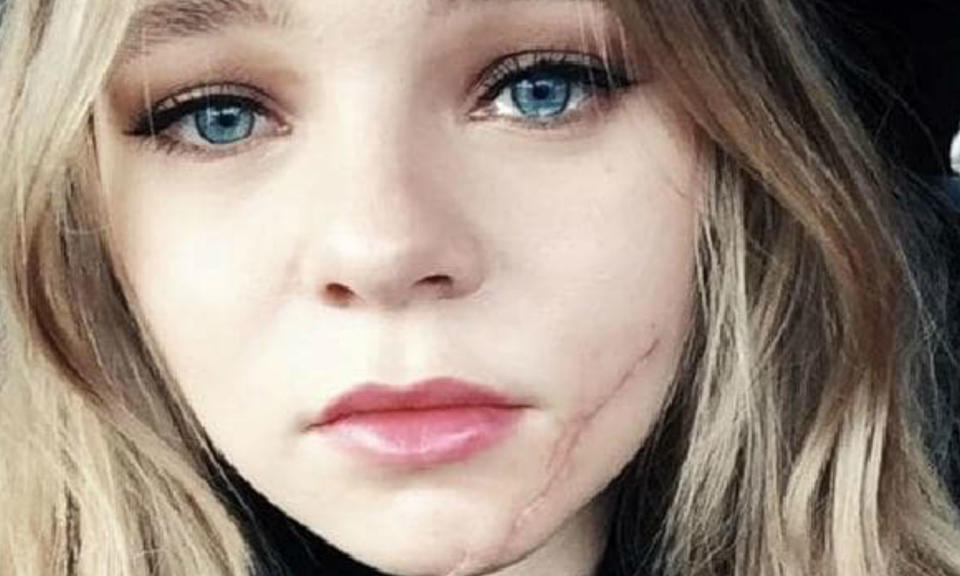 Taylor Hickson suffered facial lacerations on Ghostland