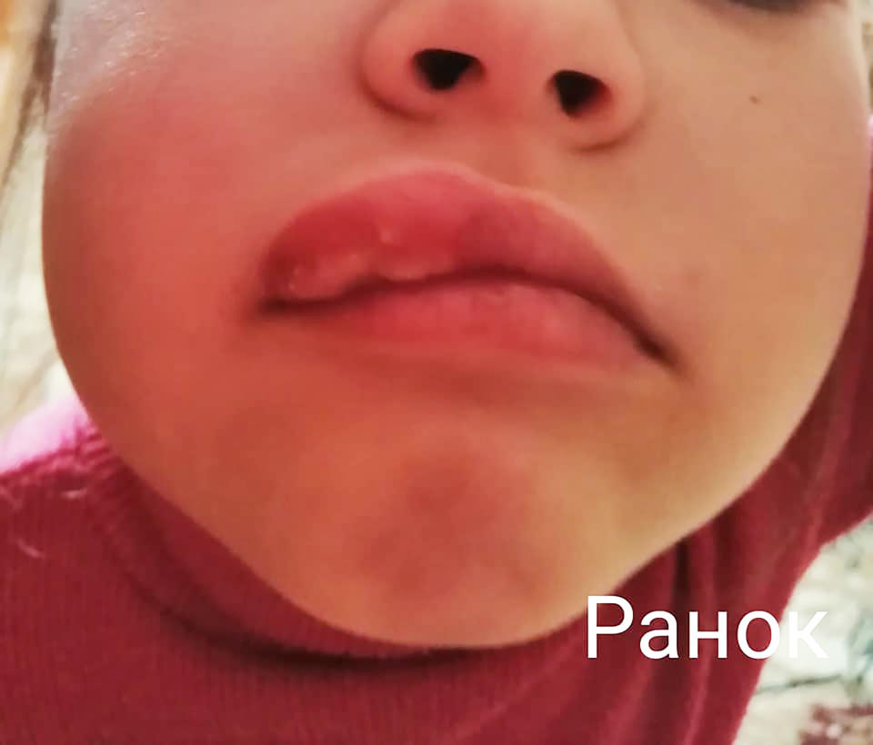 A young girl is seen with swollen lip. Source: Australscope