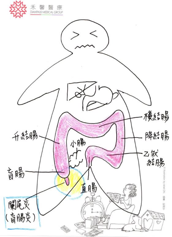 詹宜學醫師手繪盲腸炎發生位置。（圖／肝膽腸胃科詹宜學醫師提供）