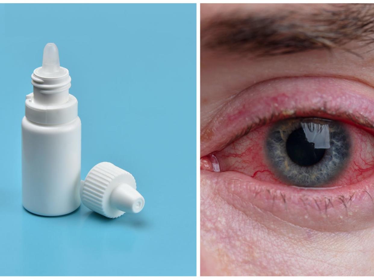 Stock images showing a bottle of eye drops and a person with an eye infection.