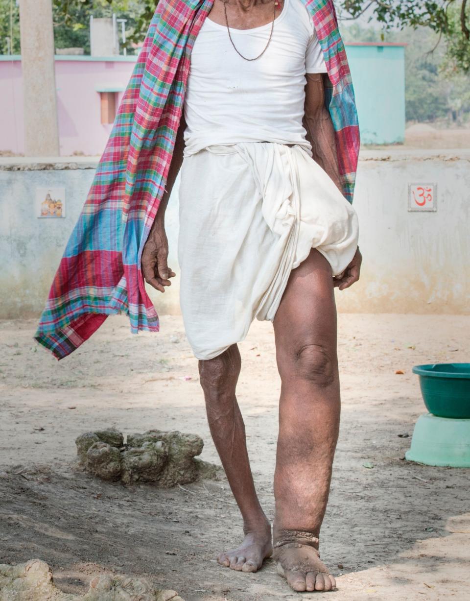 A man in India displaying symptoms of&nbsp;lymphatic filariasis, commonly known as elephantiasis, a neglected tropical disease that causes skin and tissue swelling. (Photo: DNDi / Maneesh Agnihotri)