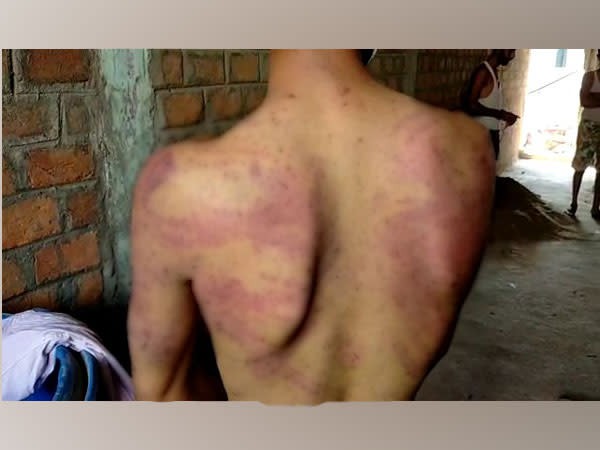 Victim Raj Verma showing several injury marks on his back (Photo/ANI)