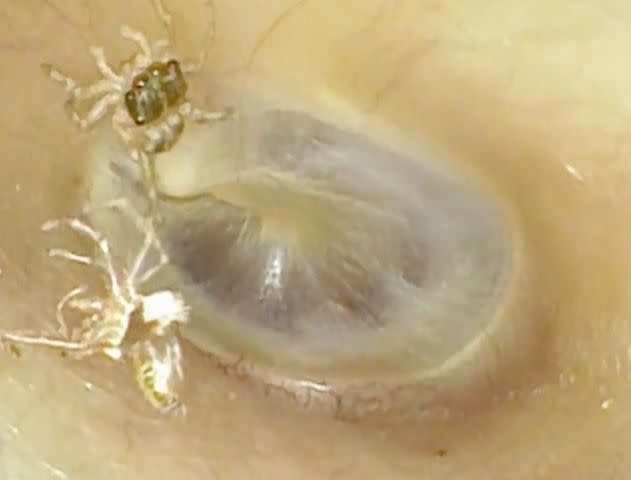 <p>New England Journal of Medicine</p> The spider's exoskeleton was also in the woman's ear canal.