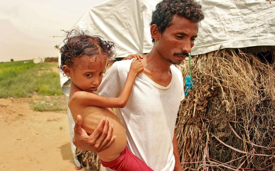 In this file photo taken on September 23, 2020, displaced Yemeni Samar Ali Ahmed, 8-year-old weighing nine and a half kilogrammes suffering from acute malnutrition, is carried by her father in Hajjah Governorate, in northern Yemen. - Nearly 200 charities on November 20, 2020, urged Britain's Prime Minister Boris Johnson to abandon plans to cut Britain's international development budget as it grapples with the economic fallout of the coronavirus pandemic. - AFP