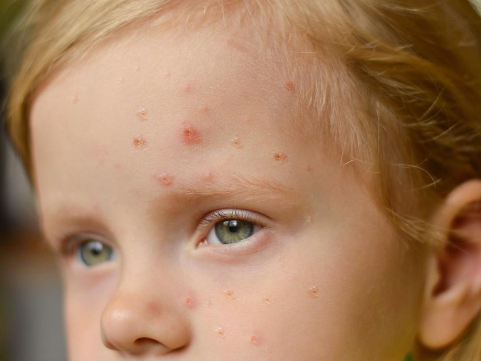 A child suffering from scarlet fever (Getty/iStock)