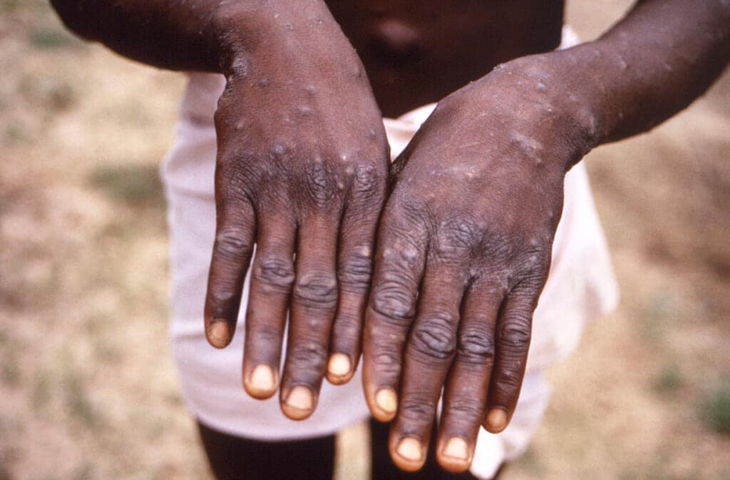 This 1997 image provided by the CDC during an investigation into an outbreak of monkeypox, which took place in the Democratic Republic of the Congo (DRC), formerly Zaire, and depicts the dorsal surfaces of the hands of a monkeypox case patient. (CDC via AP, File)