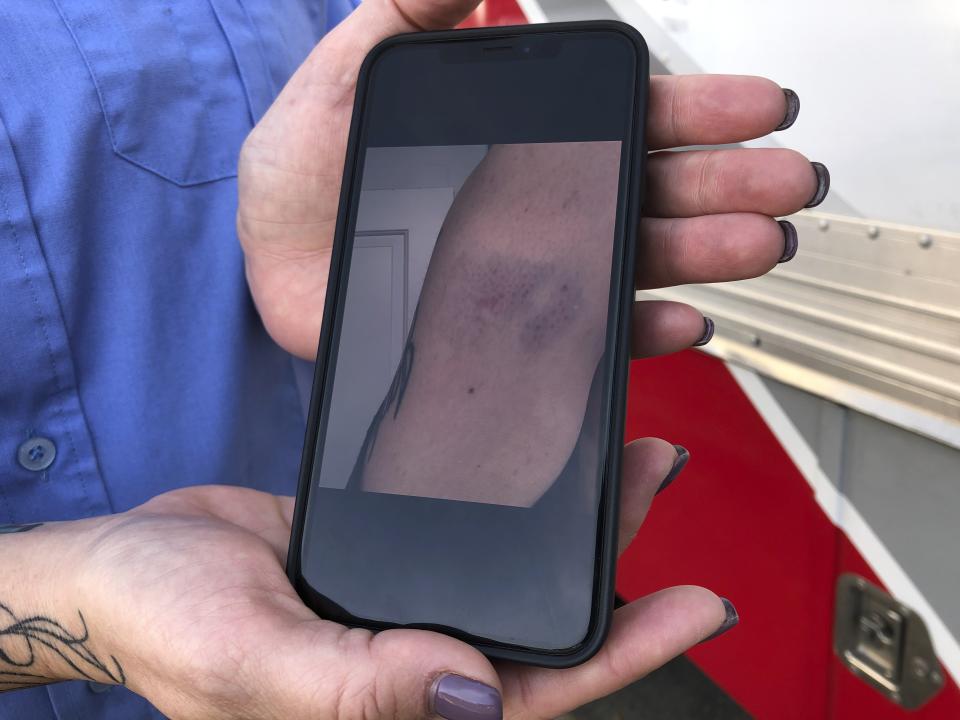 In this photo taken Nov. 6, 2019, Trisha Preston, a paramedic, displays a photo on her phone showing one of her recent injuries on the job outside the headquarters of her employer, American Medical Response, in Portland, Ore. Preston was attacked in the back of her ambulance by a patient in a mental illness earlier this year and sustained bruising, bite marks and a concussion that left her with temporary double vision and headaches. AMR, the private ambulance company that holds Portland's 911 contract, is now providing training in defensive tactics to more than 500 paramedics this fall in response to a wave of high-profile attacks on its employees. (AP Photo/Gillian Flaccus)