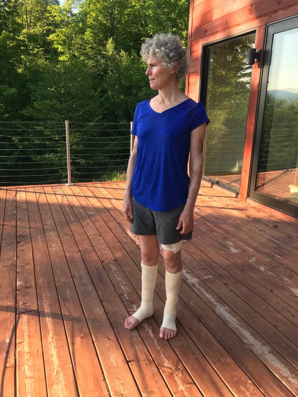 Dominique Alain's legs and arm still bear the scars left by her canine attackers, leaving her wounded and disfigured for life.