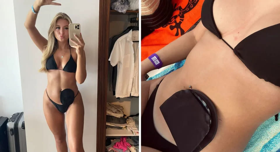 Ellie Berdasmore (20) hat gelernt, zu ihrem Stomabeutel zu stehen und ihr Selbstbewusstsein durch das Tragen von Bikinis zu stärken. (@ellsstomajourney/Caters)
