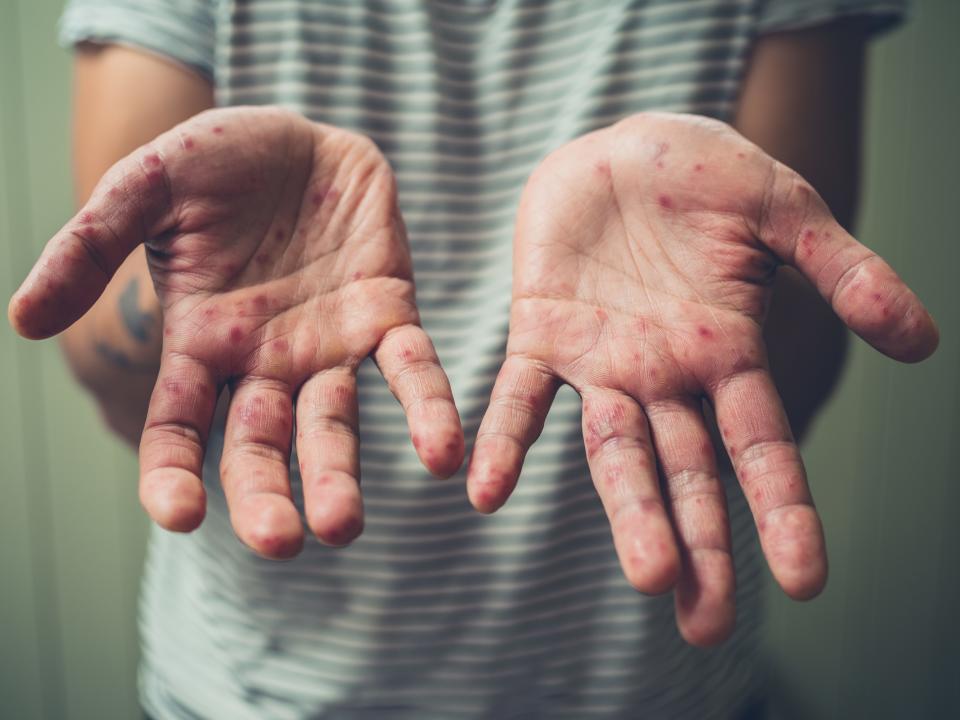 Man with hand, foot, and mouth disease showing hands.