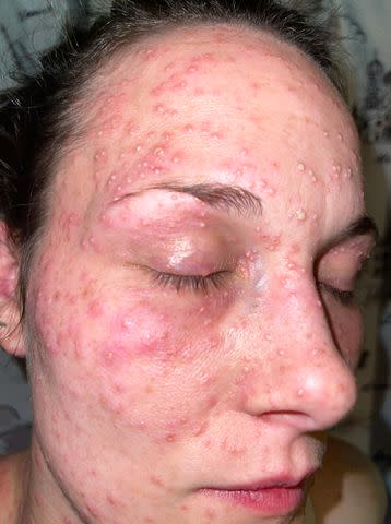 <p>Kallinen Law PLLC</p> On a GoFundMe page set up to pay for her legal expenses, her lawyer, Randall Kallinen, claims she was bitten by more than 300 fire ants during her August 2021 arrest.