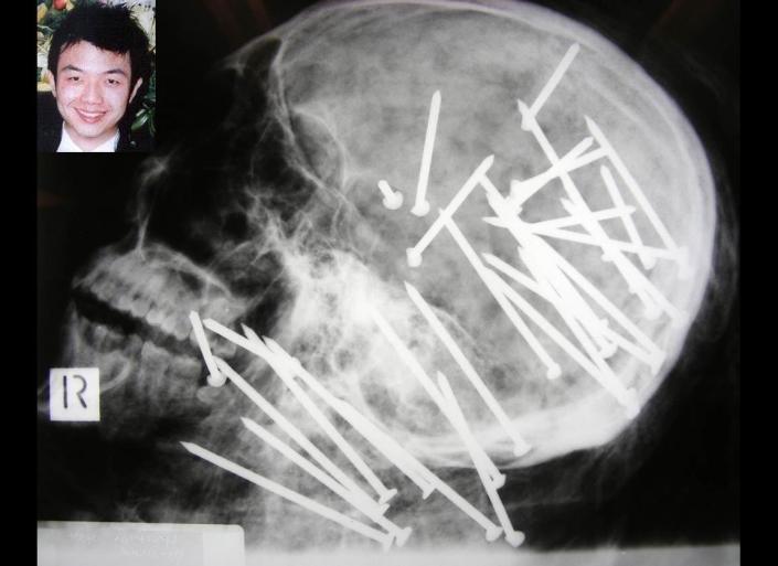 Police in Sydney, Australia, released this X-ray of the skull of Chen Liu, 27, who died after being shot in the head with a nail gun 34 times. Liu's bound body was found in a river in November. The photo was released as part of a public plea for more information in the case. Liu is shown on the upper left in an undated photo. 
