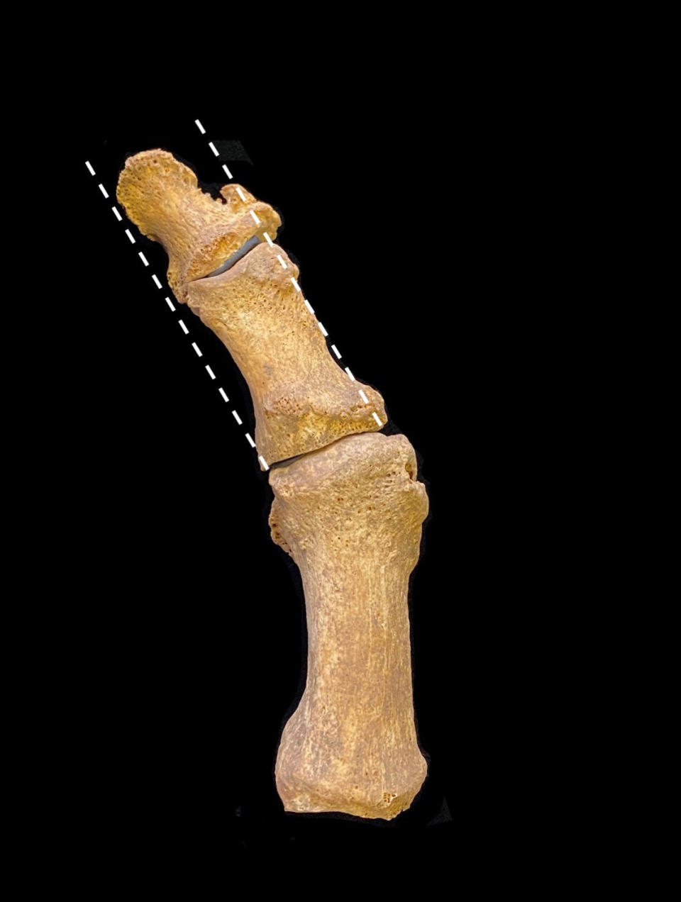 The excavated medieval foot bones show a bunion. (Supplied: Dr Jenna Dittmar)