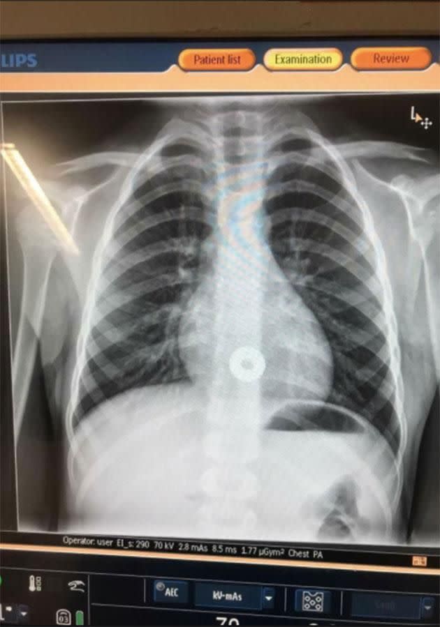 The X-ray of the boy's chest. Photo: Facebook