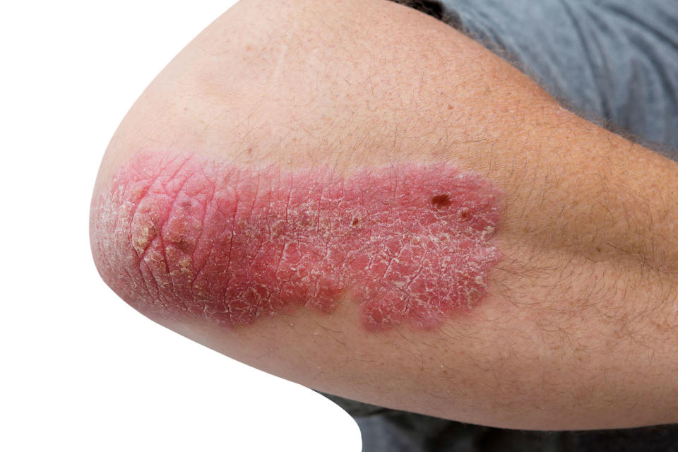 Psoriasis plaques can be scaly and itchy. (Getty Images)