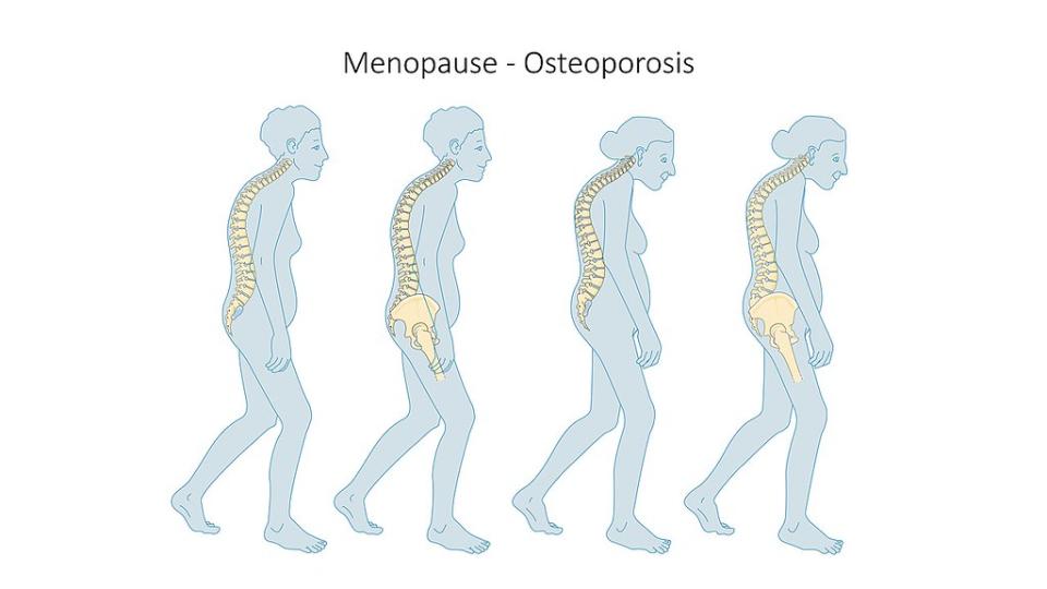 1280px-Menopause_-_Osteoporosis_--_Smart-Servier