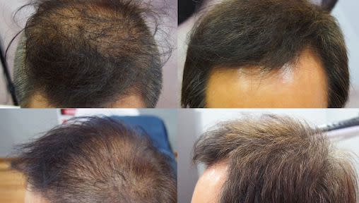 Best Hair Loss Treatments in Malaysia That You Need To Try Today