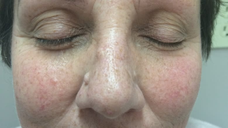 'Alison 2.0': Cancer survivor gets confidence boost from eyebrow microblading