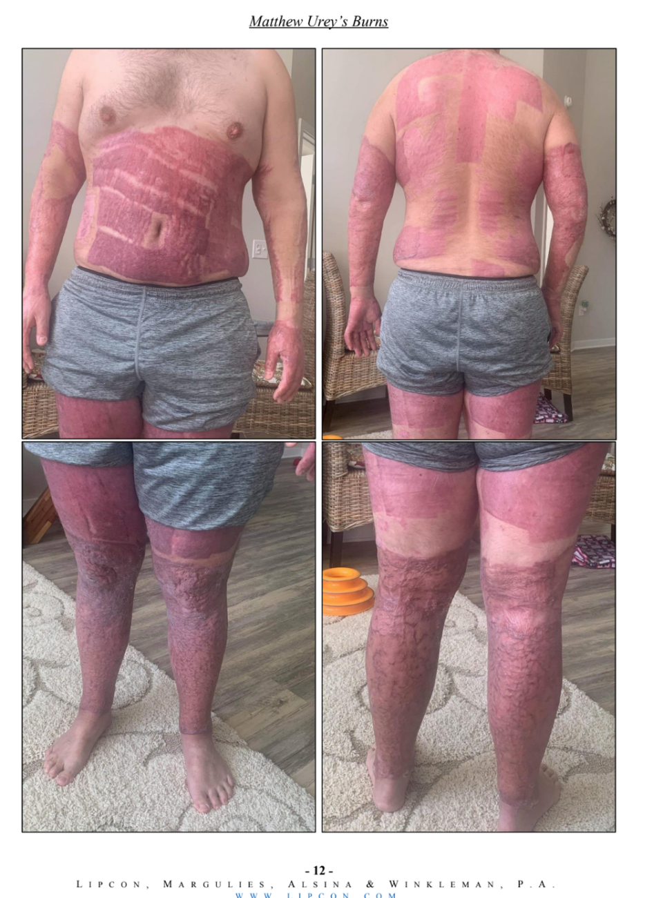 Matt Urey suffered burns to 54 per cent of his body in the 2019 White Island eruption (Courtesy of Mike Winkleman)