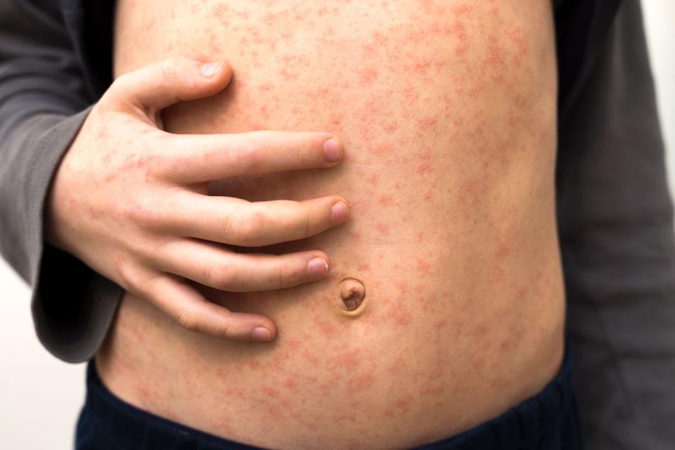 <p>Getty</p> Measles rash.