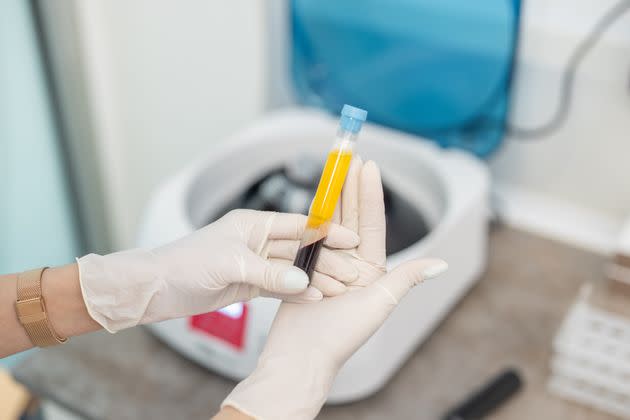 A patient's blood is spun in a centrifuge to obtain platelet-rich plasma.