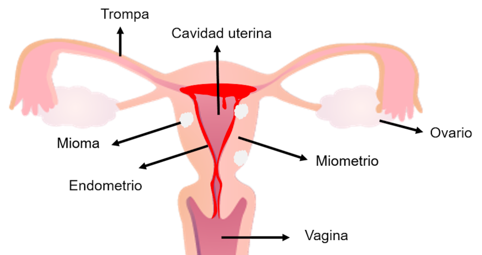 Estructura de un útero humano con tres miomas y en la fase de menstruación, con desprendimiento del endometrio.