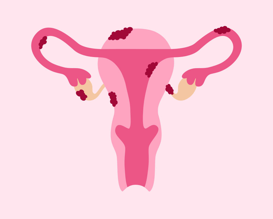 Endometriosis Disease. Uterus With Tissue Growth