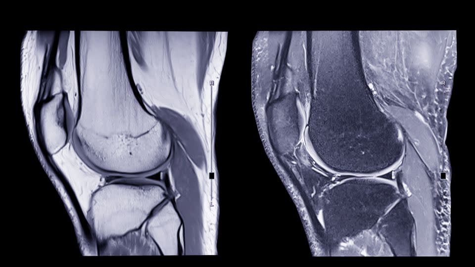 Magnetic resonance imaging or MRI knee comparison sagittal PDW and TIW view for detect tear or sprain of the anterior cruciate ligament. - iStockphoto/Getty Images