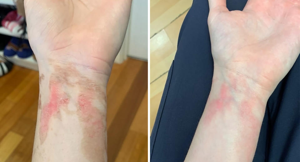 Before and after pictures of arm with second degree burns