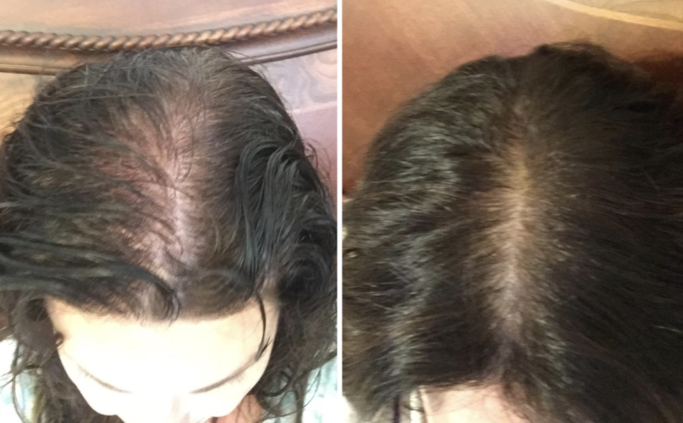 "I've been using this product for nearly a month. This picture represents Hair growth in the last month," writes this reviewer. (Photo: Amazon)